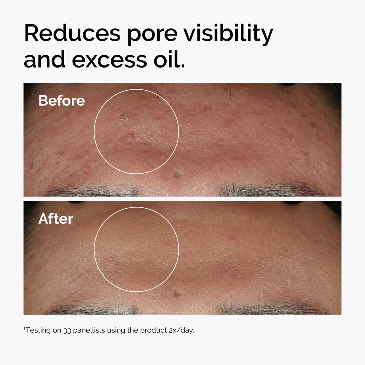 niacinamide-10-zinc-1-a9 ord-niacinamide-zinc-blemish-serum-before-after-pores.jpg