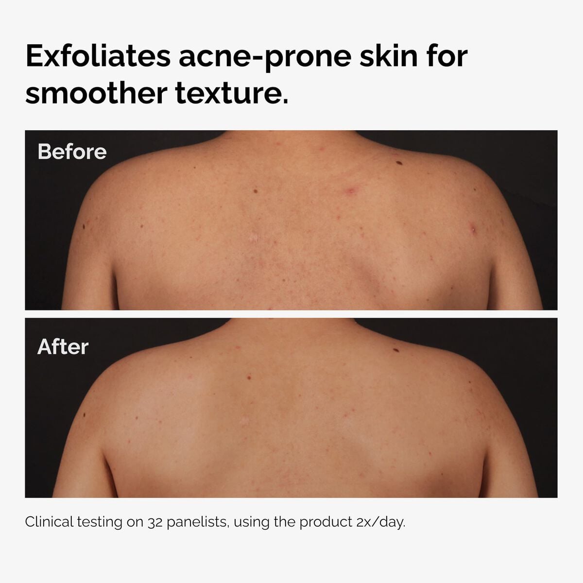 salicylic-acid-0-5-body-serum-j4 ord-salicylic-acid-body-serum-before-after-graphic-NA.jpg