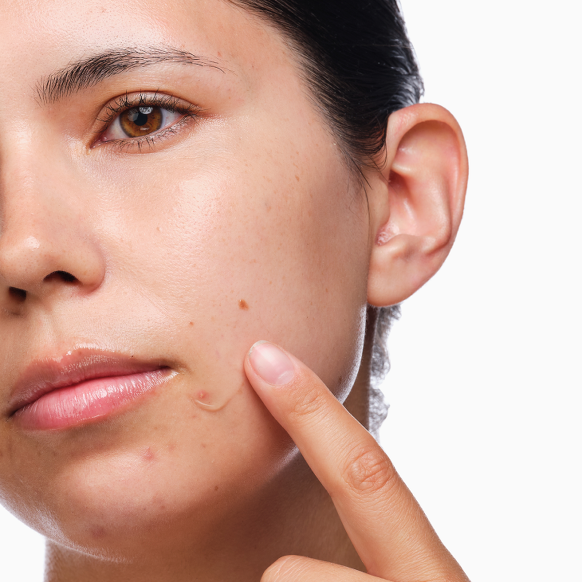 the-acne-set-r6 rdn-the-acne-set-application.png